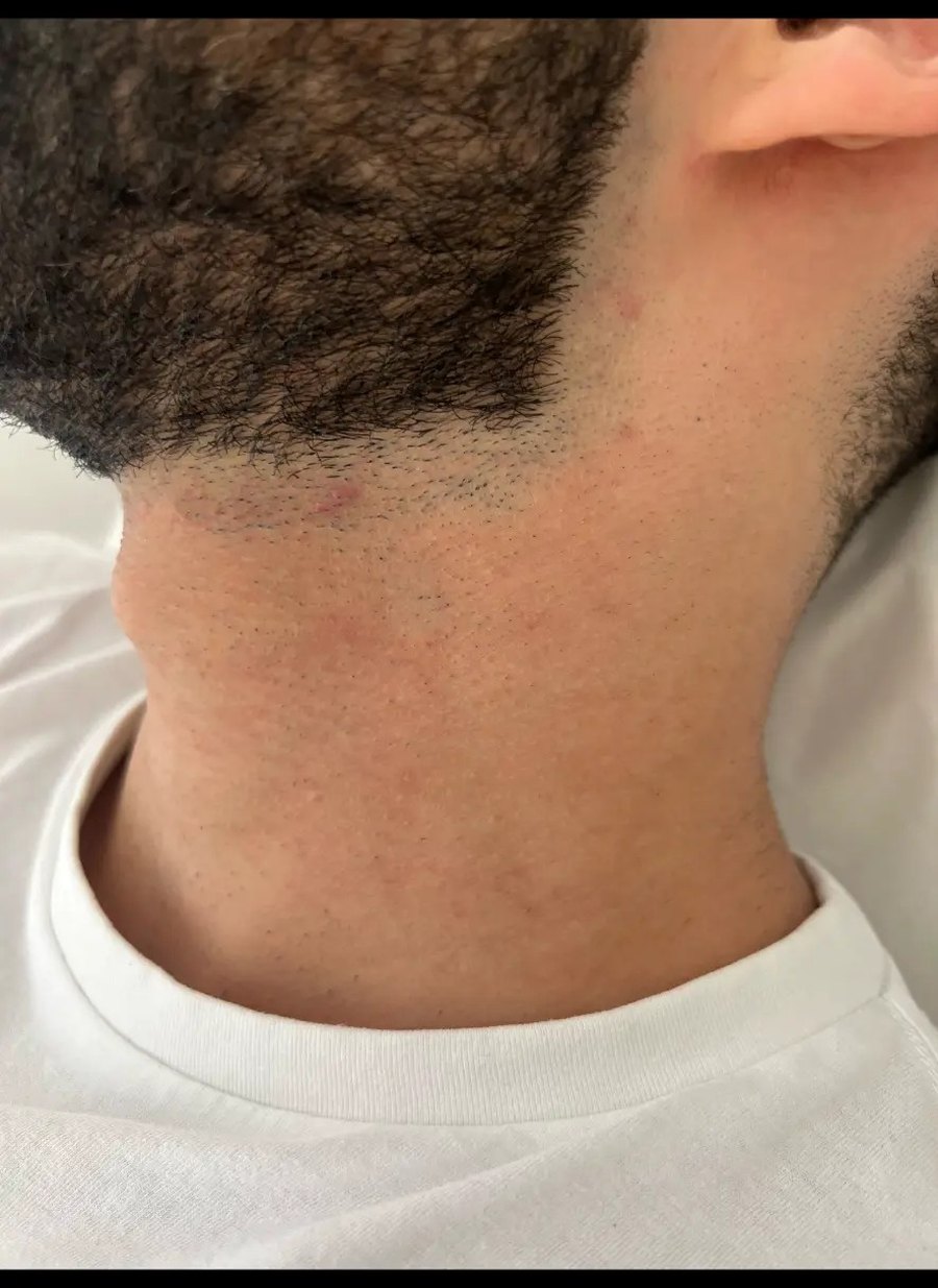 Male client's beard line and neck before laser hair removal at Dolce Laser Clinic