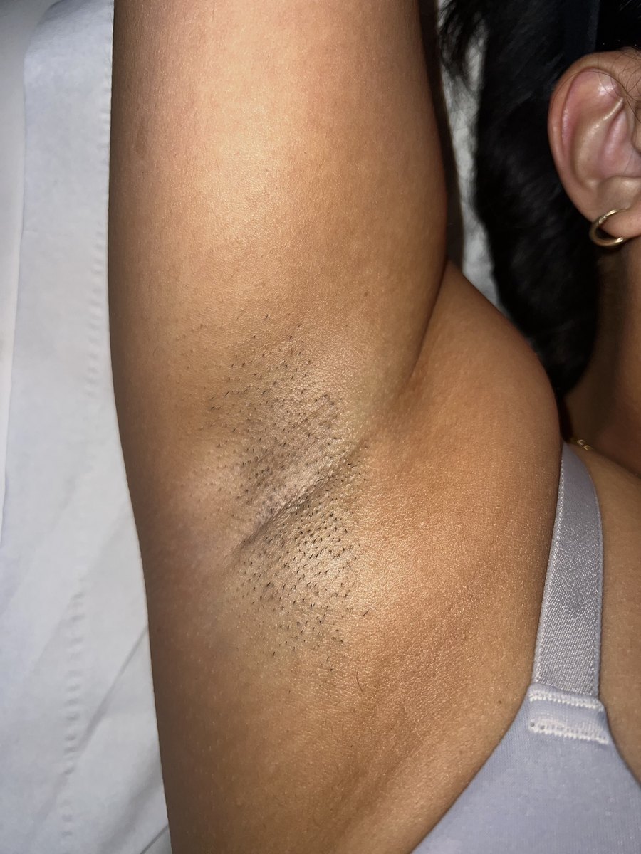 Underarm hair reduction progress photograph from Dolce Laser Clinic