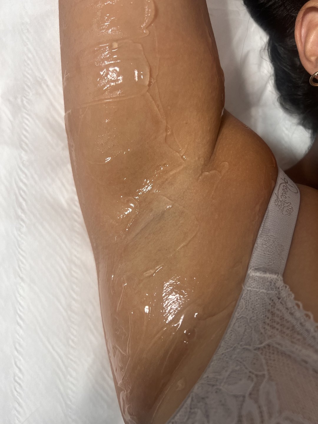 Cooling gel applied during an underarm laser hair removal session at Dolce Laser Clinic