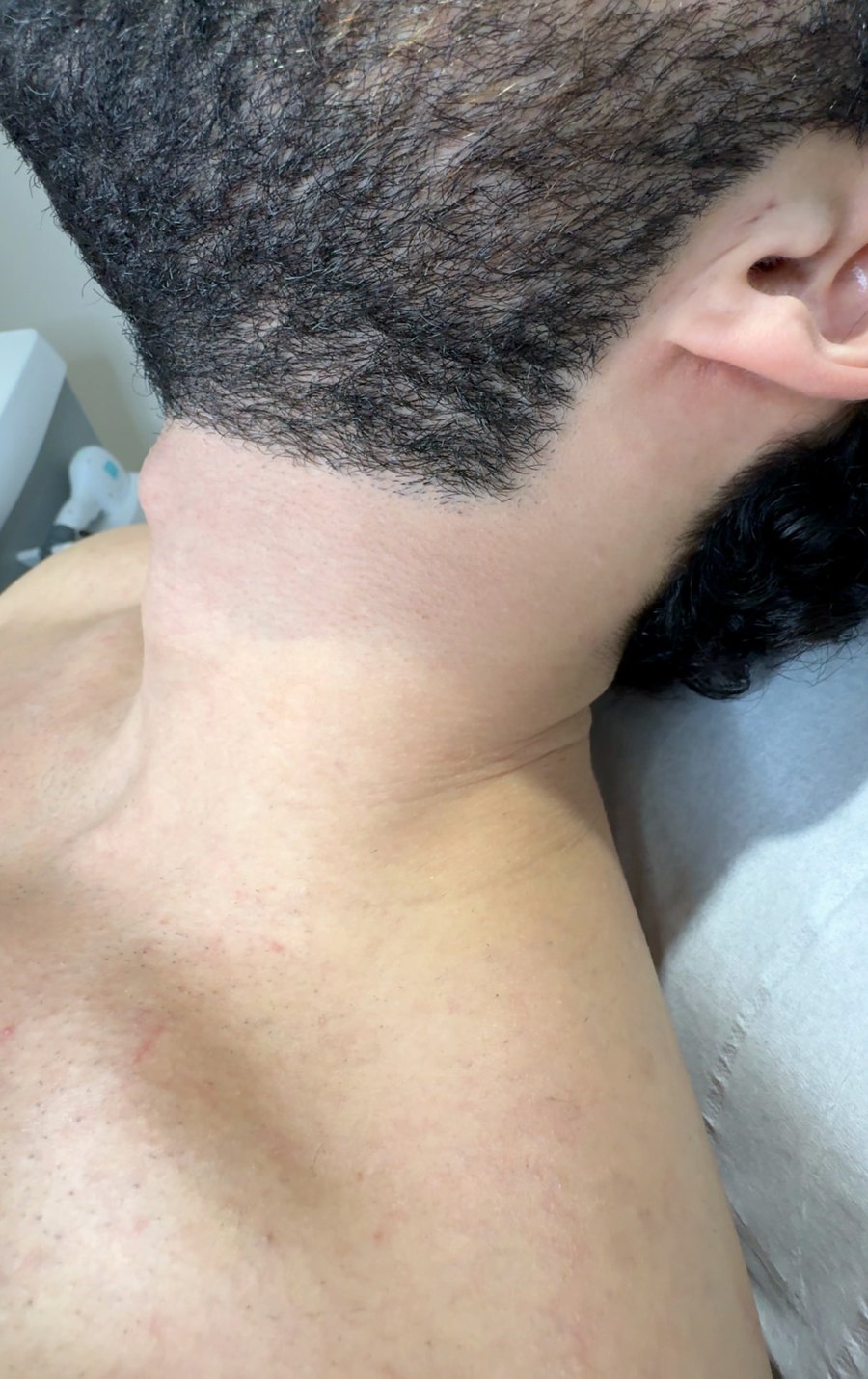 The same male client's beard line and neck after laser hair removal at Dolce Laser Clinic
